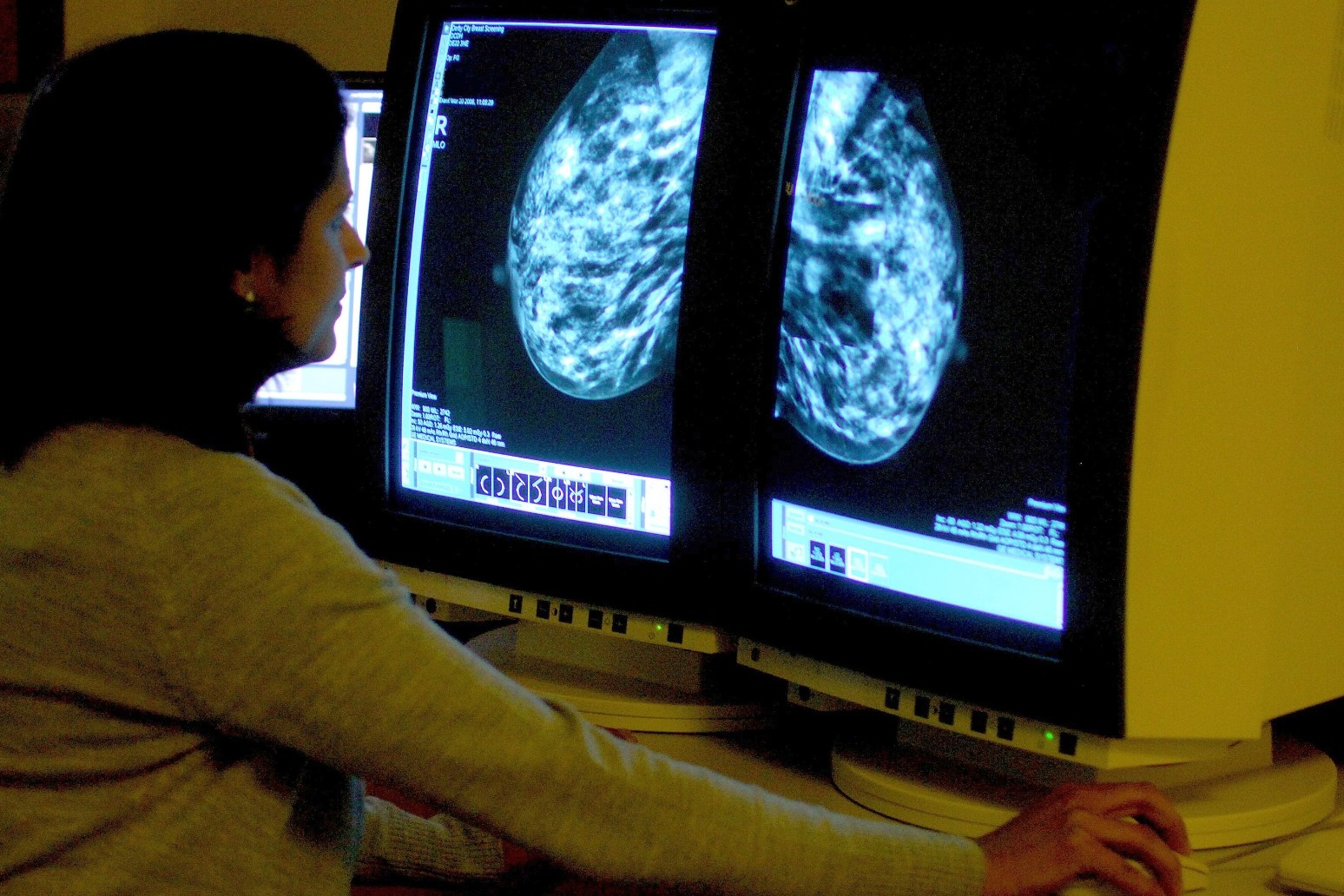 New test could revolutionise aftercare for thousands of breast cancer patients 